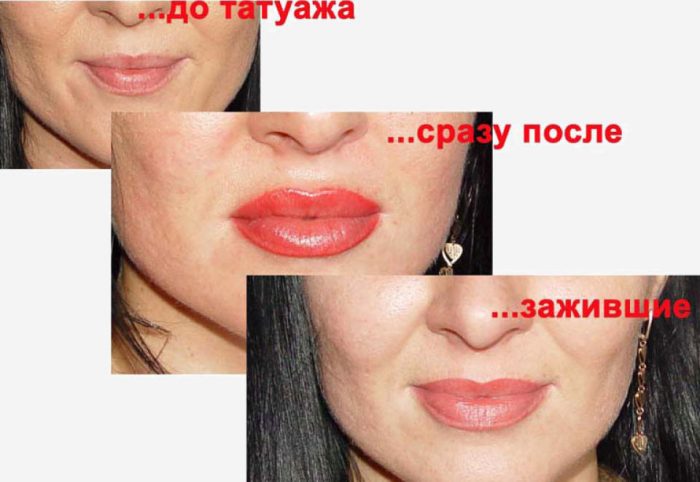 Коррекция после перманентного макияжа губ